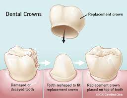 Illustration of Dental Crowns application, Honolulu, HI