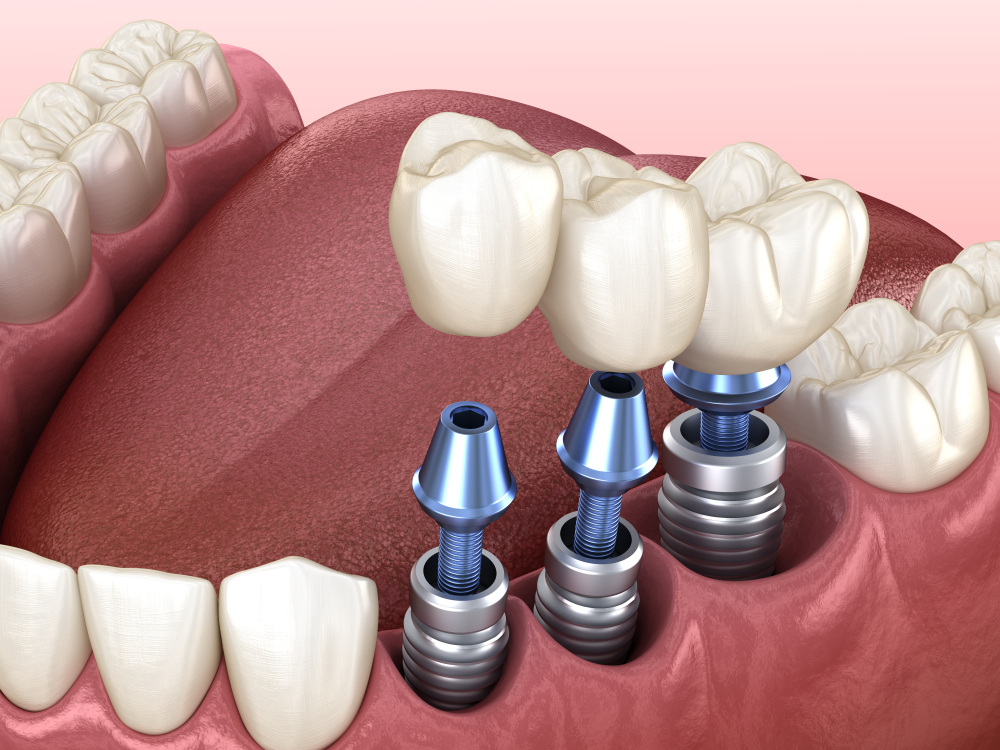 illustration of mouth with teeth and dental implants, Honolulu, HI dentist